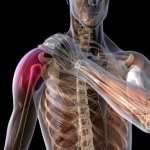 Shoulder Pain and Impingement, part 1