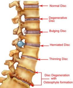 spine conditions pinched nerve